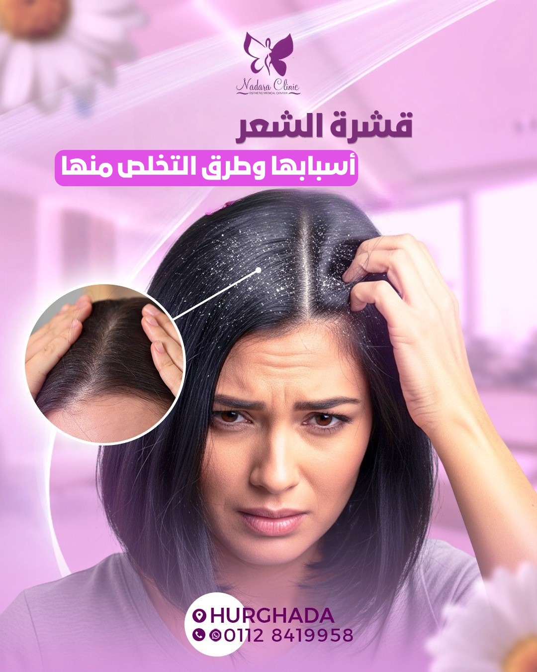 قشرة الشعر أسبابها وطرق التخلص منها في الغردقة
